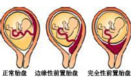 前置胎盤分哪幾種？有什么癥狀？